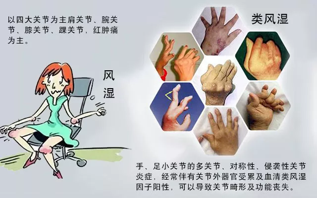 這些病癥你中了幾項？超過4項患類風(fēng)濕性關(guān)節(jié)炎的幾率極高