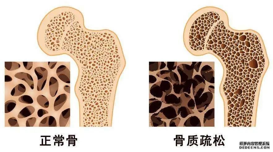 世界骨質(zhì)疏松日 | 預(yù)防“骨質(zhì)疏松”補(bǔ)鈣就可以了嗎？營養(yǎng)專家送你一份“護(hù)骨秘籍”